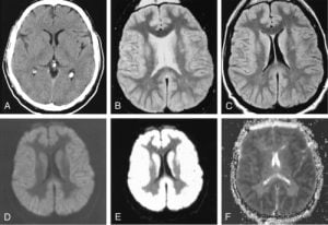 Anoxic brain injury MRI scans